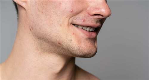 دلایل شایع جوش و آکنه