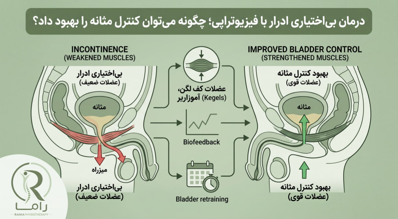 درمان بی‌اختیاری ادرار با فیزیوتراپی؛ چگونه می‌توان کنترل مثانه را بهبود داد؟